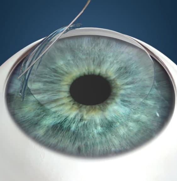 Can I Finance My Laser Vision Correction Treatment?