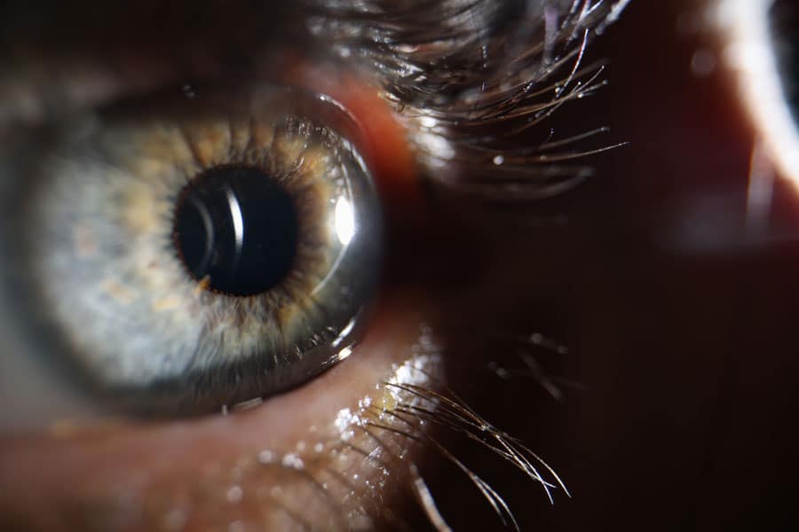 Benefits-of-evo-icl - Visionmax Eye Centre