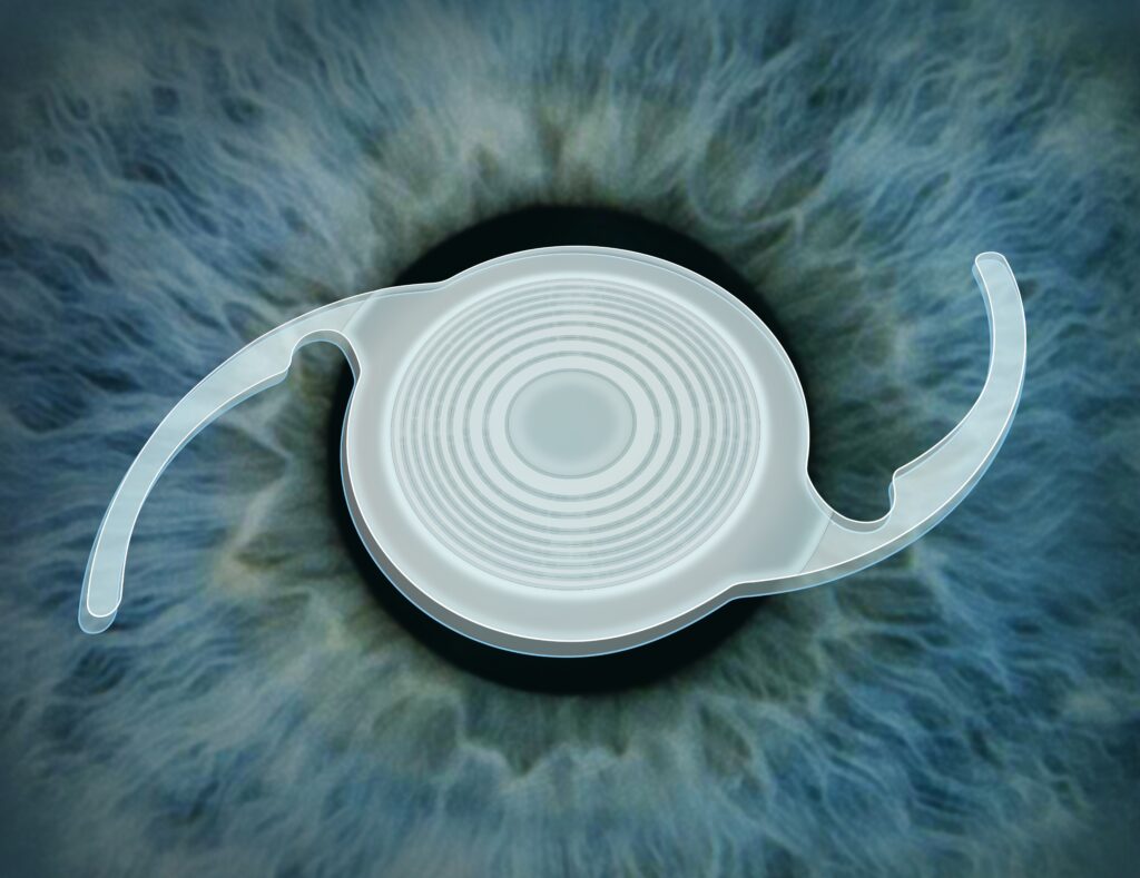 Custom Lens Replacement, Edmonton & Northern Alberta - Visionmax Eye Centre Custom Lens Replacement, Edmonton & Northern Alberta